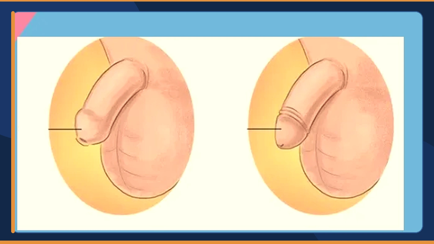3 عيوب لطهارة الذكور تعرف عليهم وعلى مضاعفاتهم