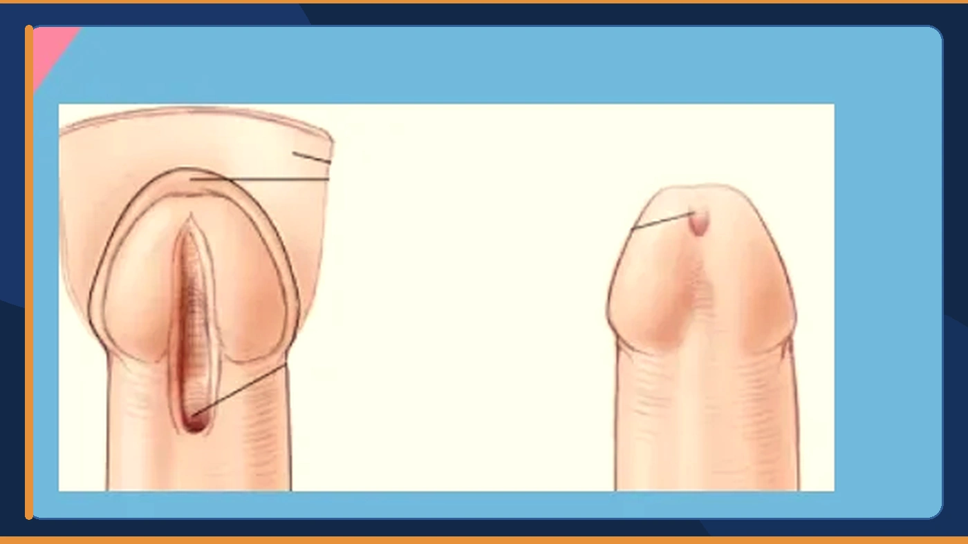 تعرف على جميع مضاعفات عملية الإحليل التحتي للأطفال