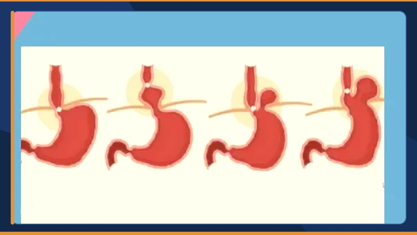 10 طرق لعلاج نهائي لفتق الحجاب الحاجز