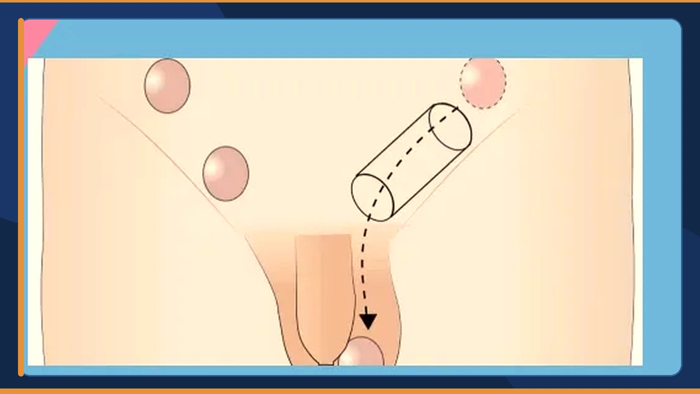 تعرف على الوقت المناسب لعملية الخصية المعلقة
