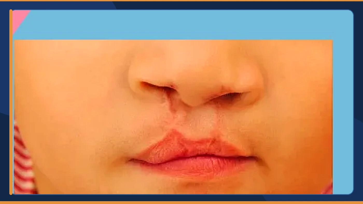 تكلفة عملية تجميل الشفة الأرنبية