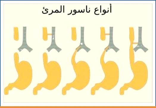 أنواع ناسور المريء