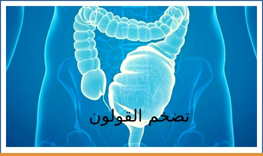 تضخم القولون