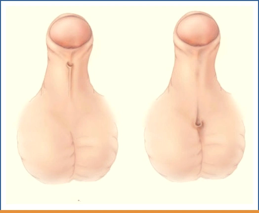 إحليل تحتي (احليل سفلي)