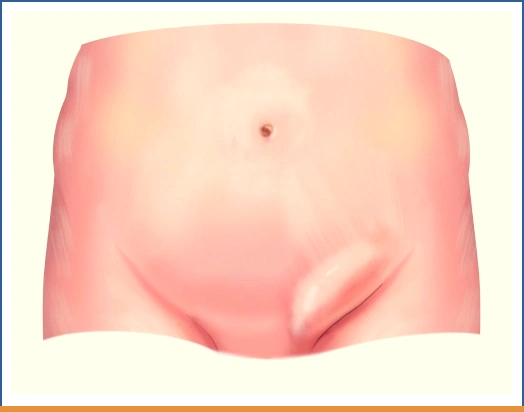 الفتق الإربي عند الرضع