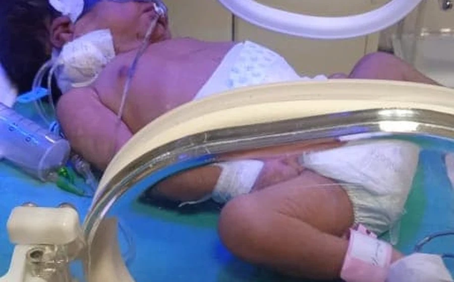 جراحة نادرة لرضيع عمره 5 أيام مصاب بانسداد كامل في المريء
